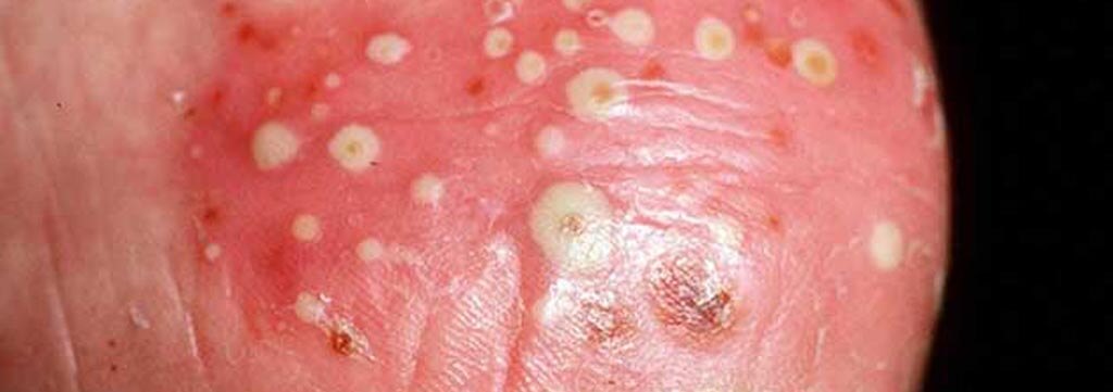 pustular psoriasis treatment