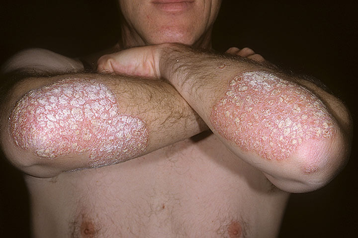 Picture of Plaque Psoriasis