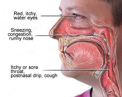 Post-Nasal-Drip