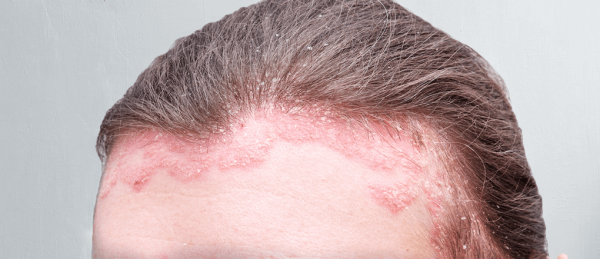 Treatment For Scalp Psoriasis: Best OTC & 9 Natural Ways To A Healthy ...