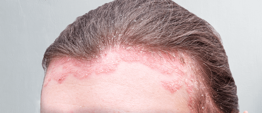 Treatment For Scalp Psoriasis Best Otc And 9 Natural Ways To A Healthy