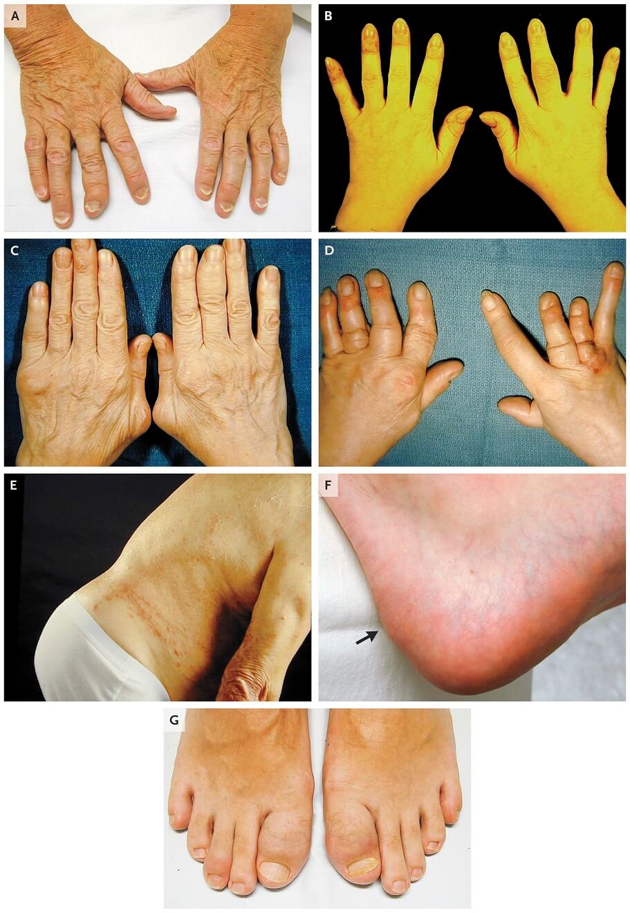 Psoriatic Arthritis