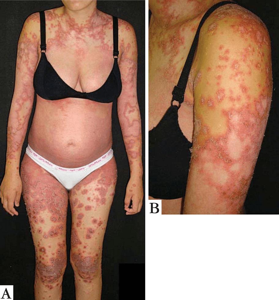 Pustular psoriasis of pregnancy (Impetigo herpetiformis)