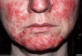 Rosacea Fulminans