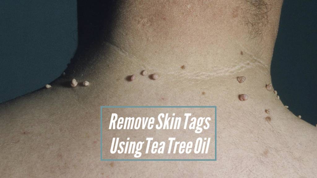 Effective Home Remedies To Remove Skin Tags