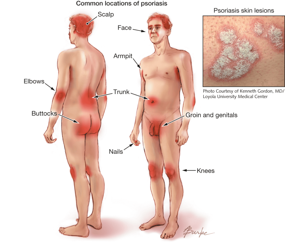 Areas on body typically affected by Psoriasis