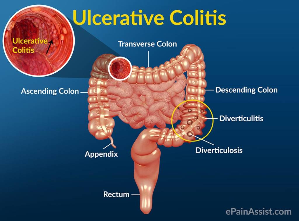How to Cure Ulcerative Colitis