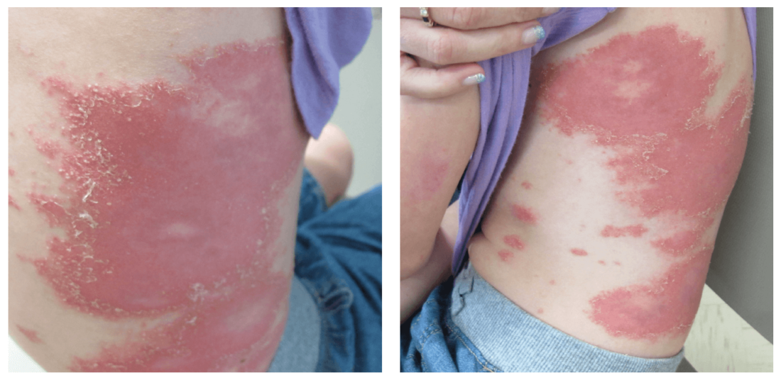 Von Zumbusch pustular psoriasis