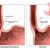 Symptoms Of Achalasia: Diagnosis & Most Effective Achalasia Treatment