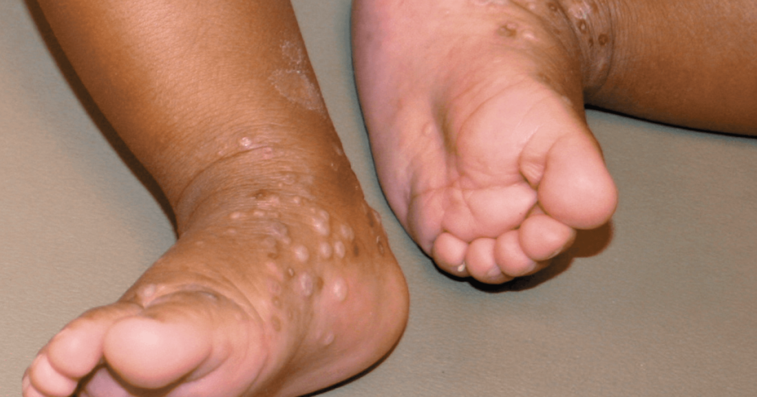 acropustulosis of infancy