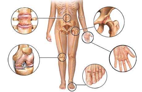 Rheumatoid Arthritis