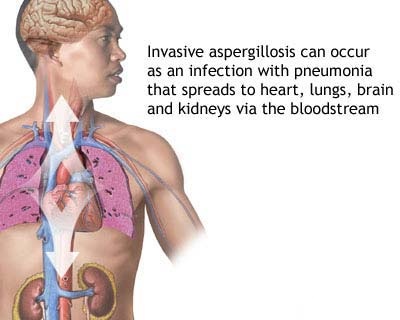 What is sinus congestion?