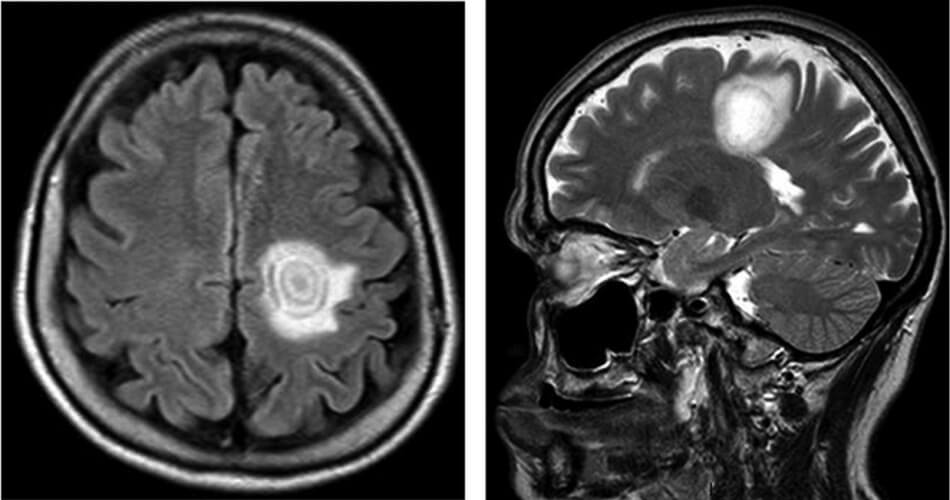 balo disease symptoms