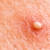How To Get Rid Of Boils