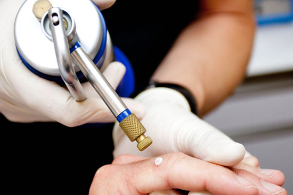 cryosurgery for warts