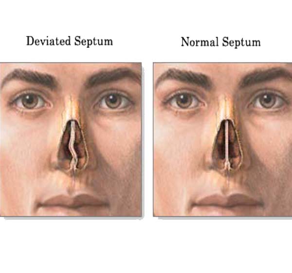 deviated-septum-before-after