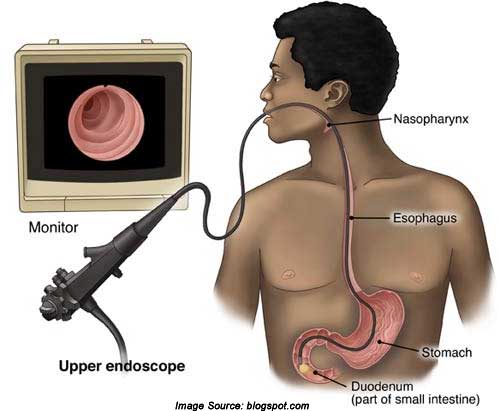 ambulatory acid probe