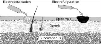 Electrodessication