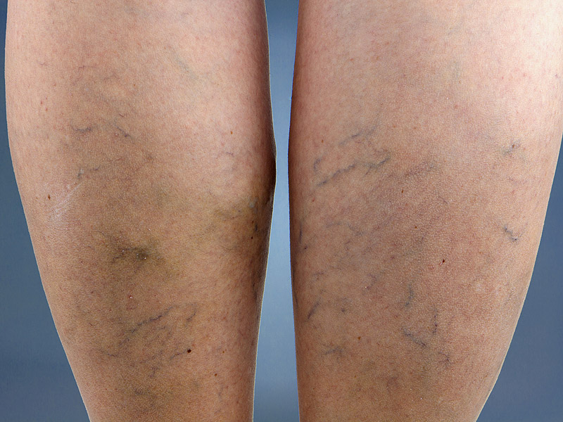 Varicose Veins Causes Symptoms Treatment and Prevention