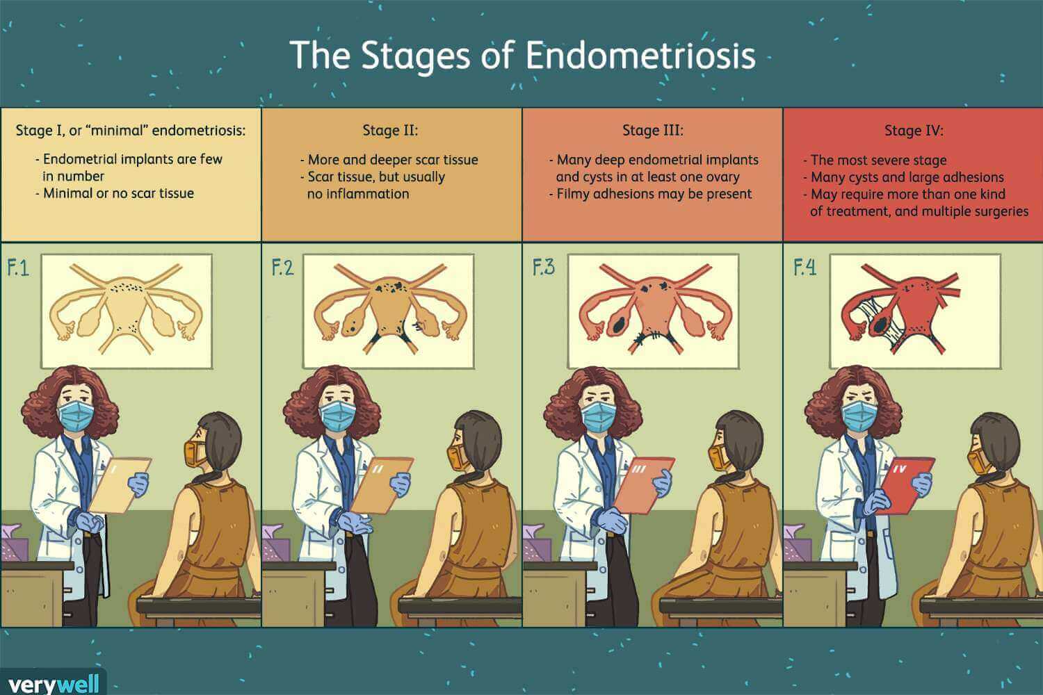 endometriosis stages