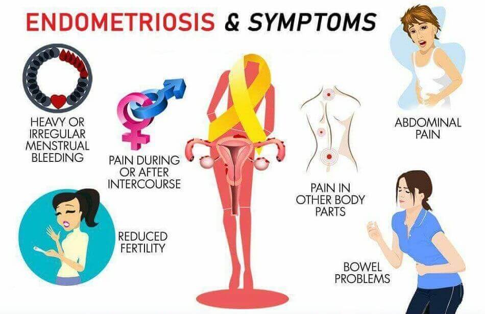 endometriosis symptoms