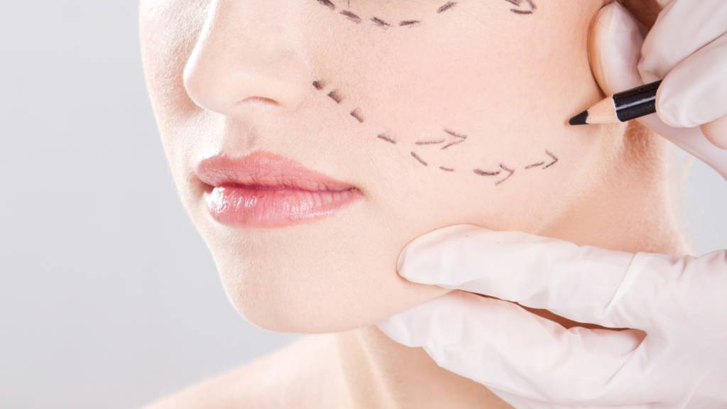 Secondary Facelift Surgery