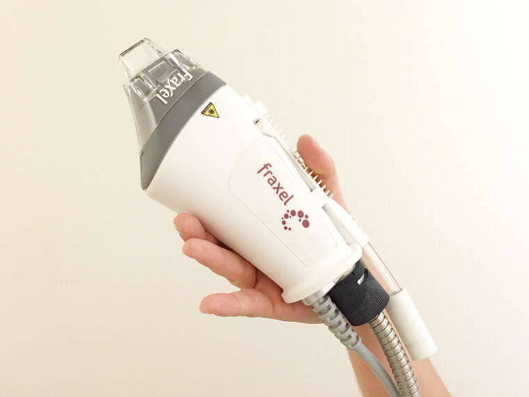 Fraxel Laser for Stretch Marks