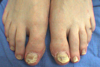 best treatment for toenail fungus