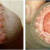 genital warts