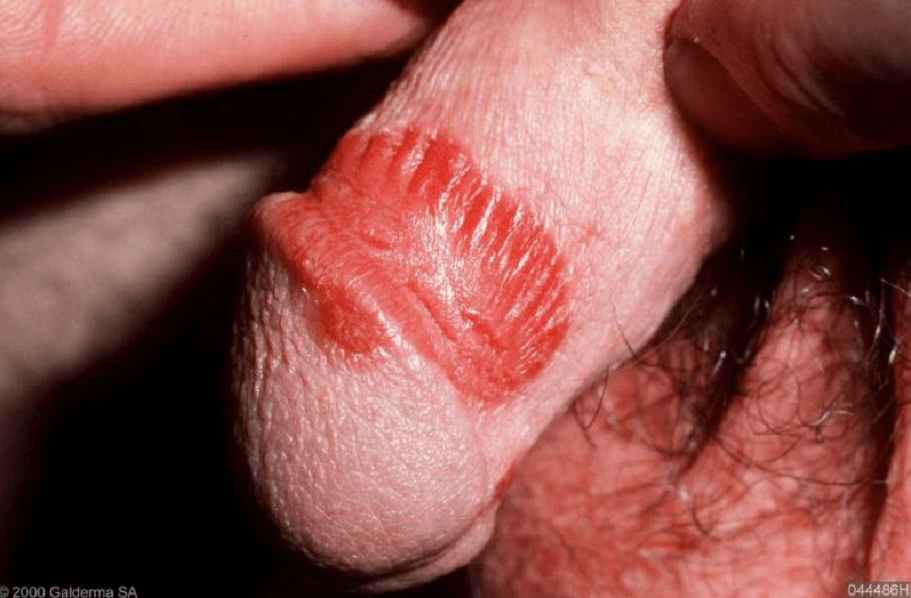 genital psoriasis