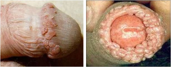 genital warts