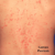 Guttate Psoriasis Treatment