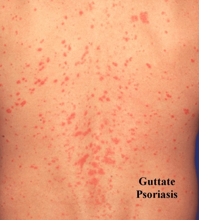 guttate psoriasis