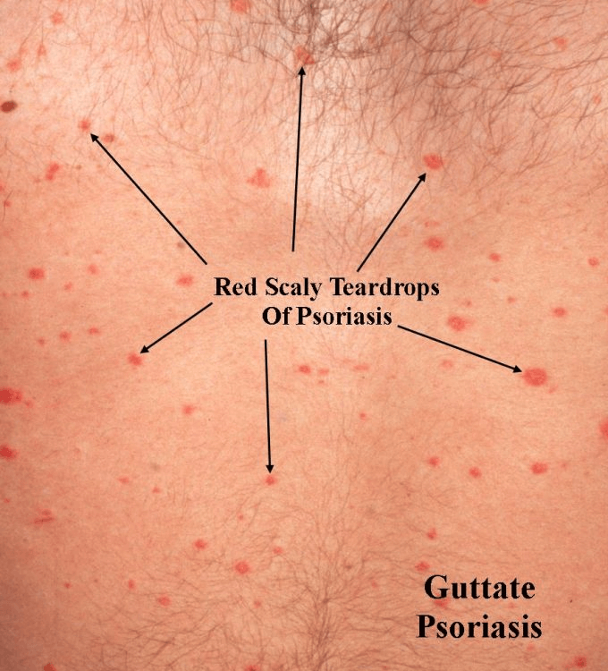 Guttate Psoriasis