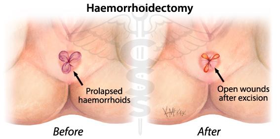 haemorrhoidectomy