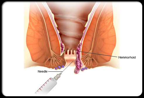 Sclerotherapy for hemorrhoids