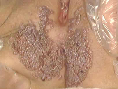 genital warts