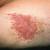 Home remedies for yeast infection