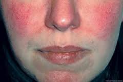 Erythematotelangiectatic rosacea