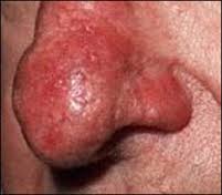 Papulopustular rosacea