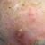 Four Treatments for Actinic Keratosis
