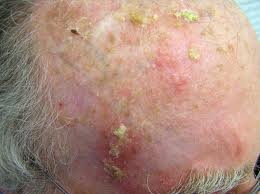 Four Treatments for Actinic Keratosis