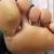 getting rid of plantar warts