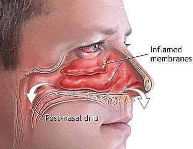 home remedy for sinus congestion