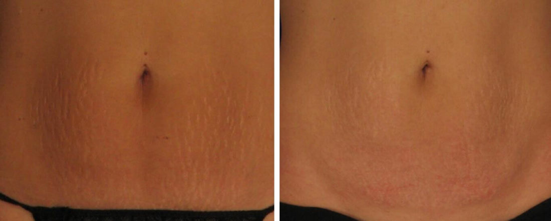 laser stretch mark removal before and after