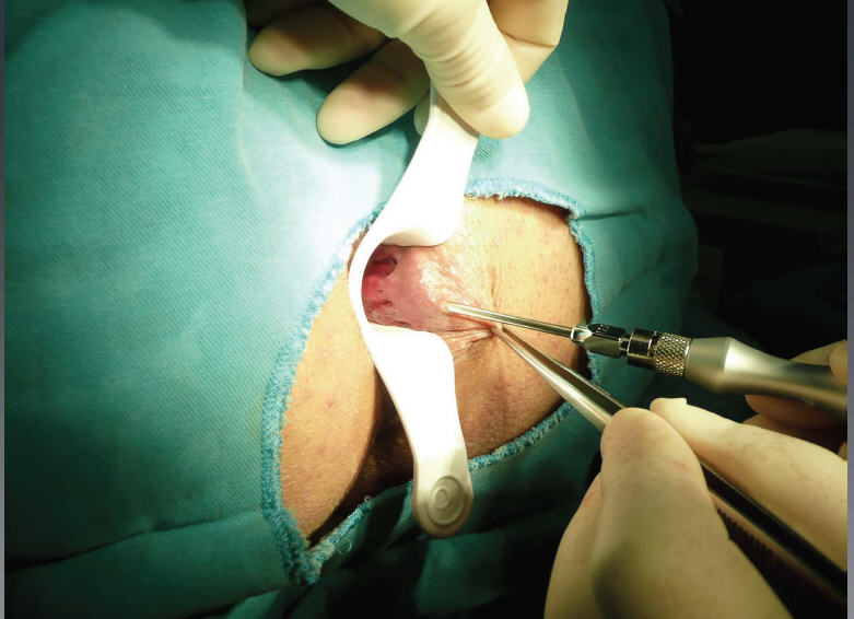 hemorrhoids laser surgery