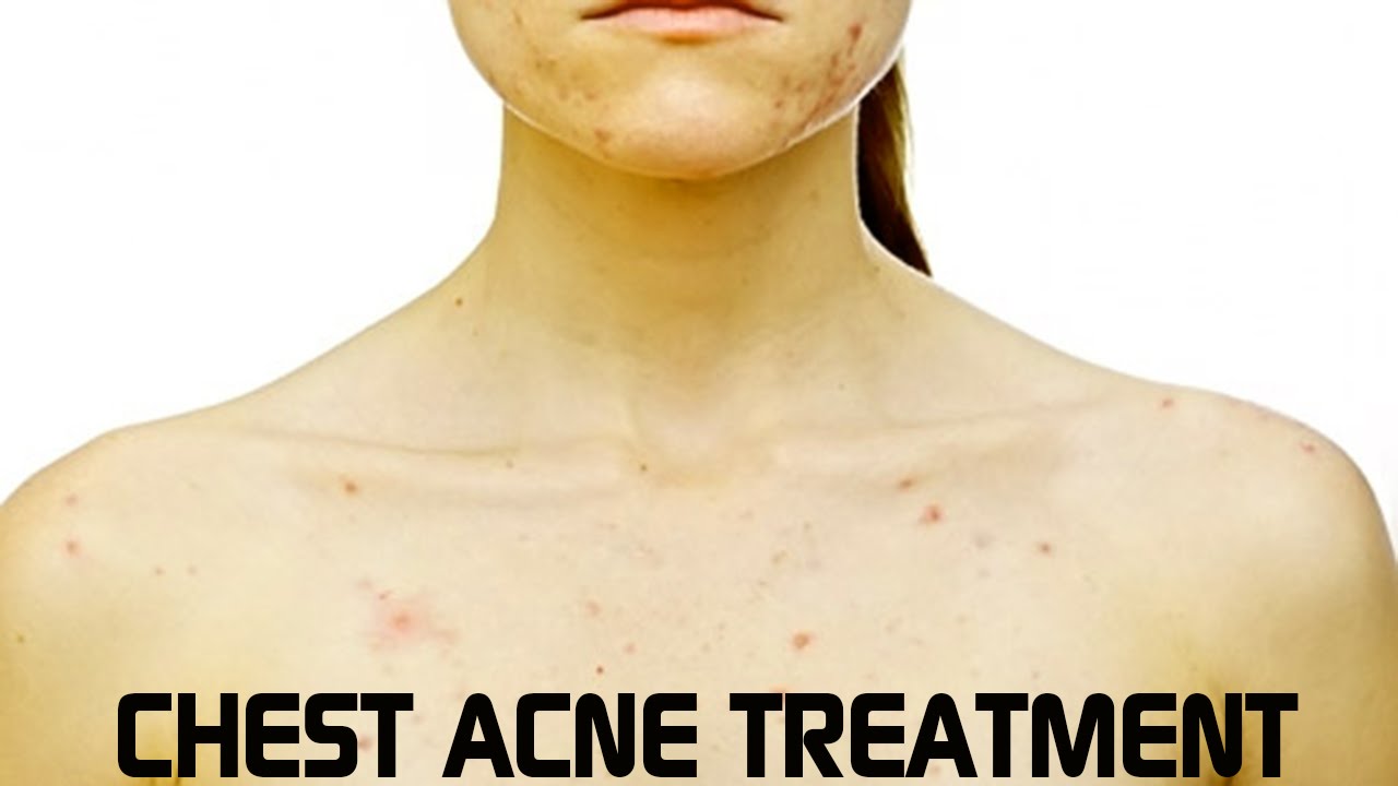 How To Get Rid Of Chest Acne Be Your Best, Well, Self