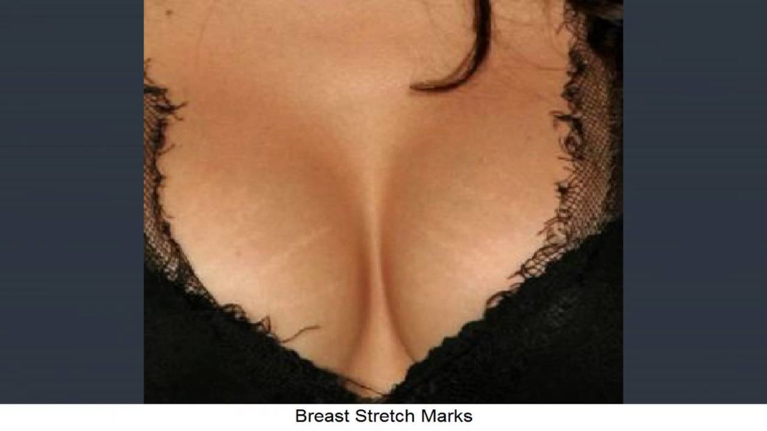 breast stretch marks
