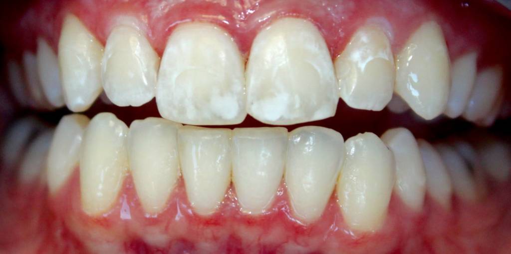 How To Get Rid of White Spots on Teeth