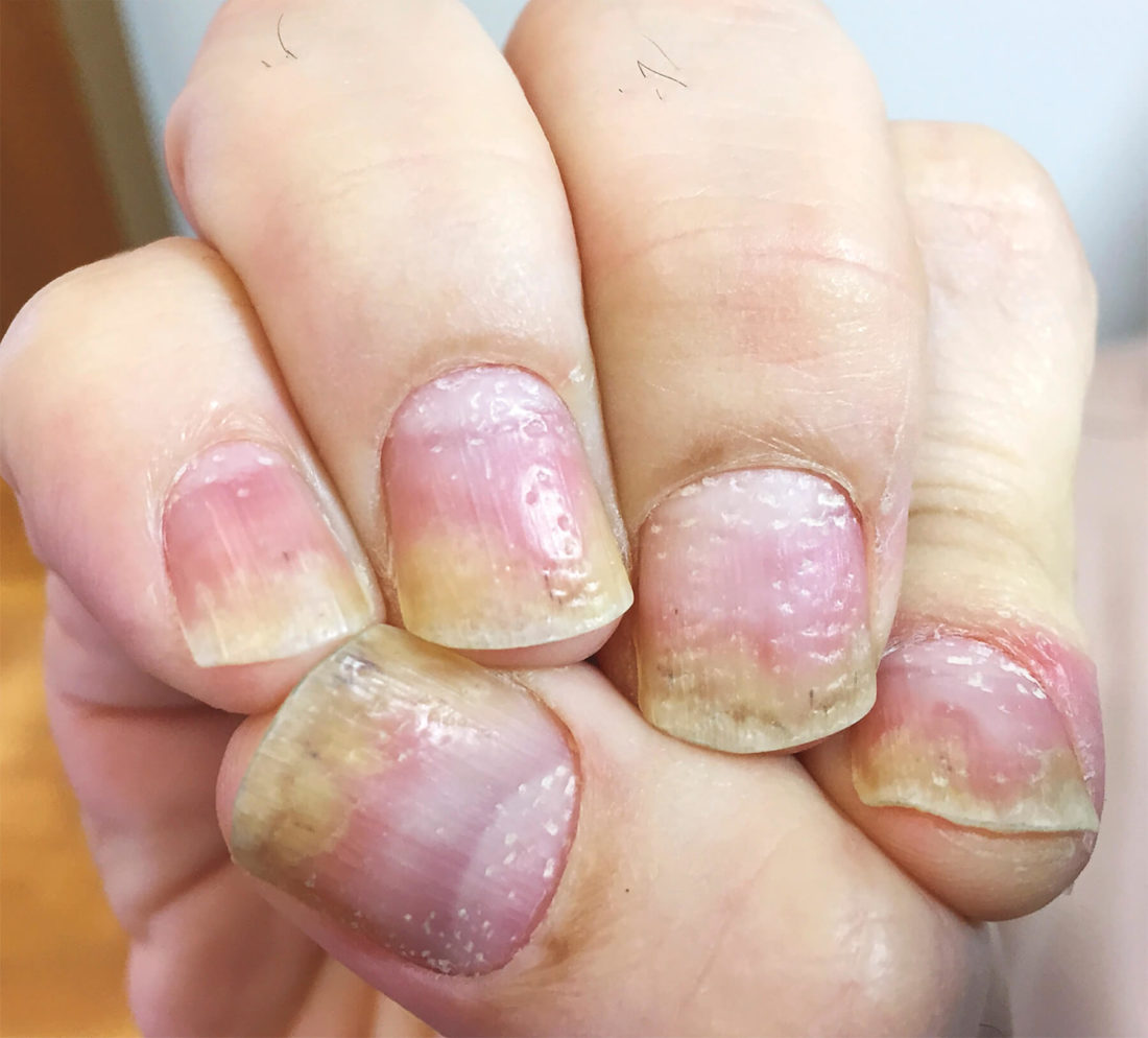 nail psoriasis